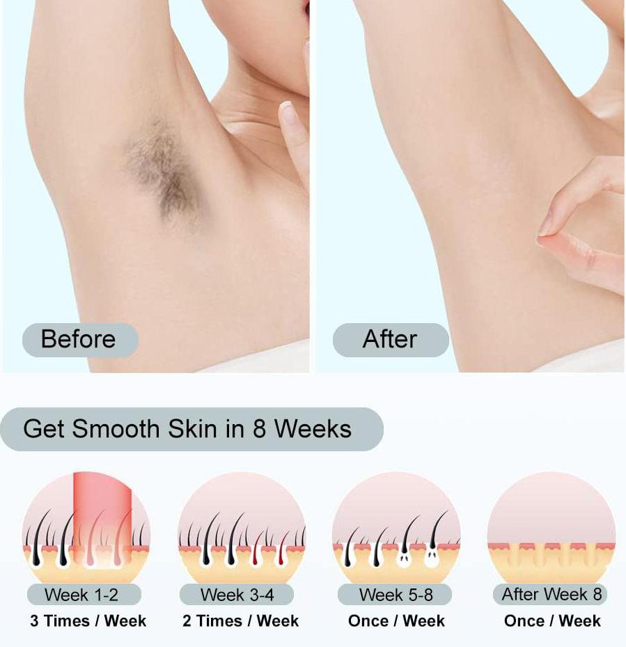 S2 Laser Hair Removal